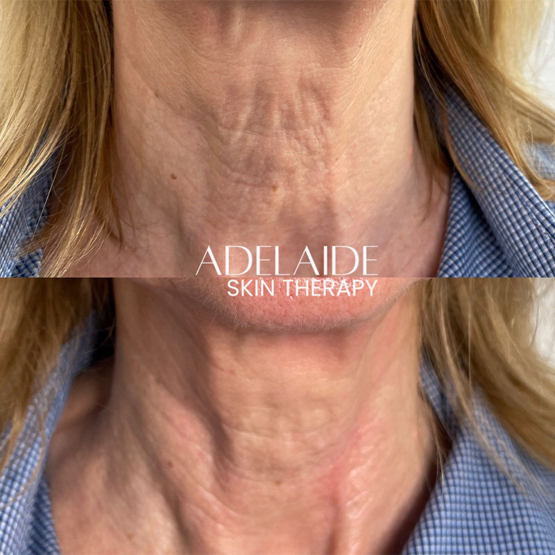 Forma Neck wrinkle reduction